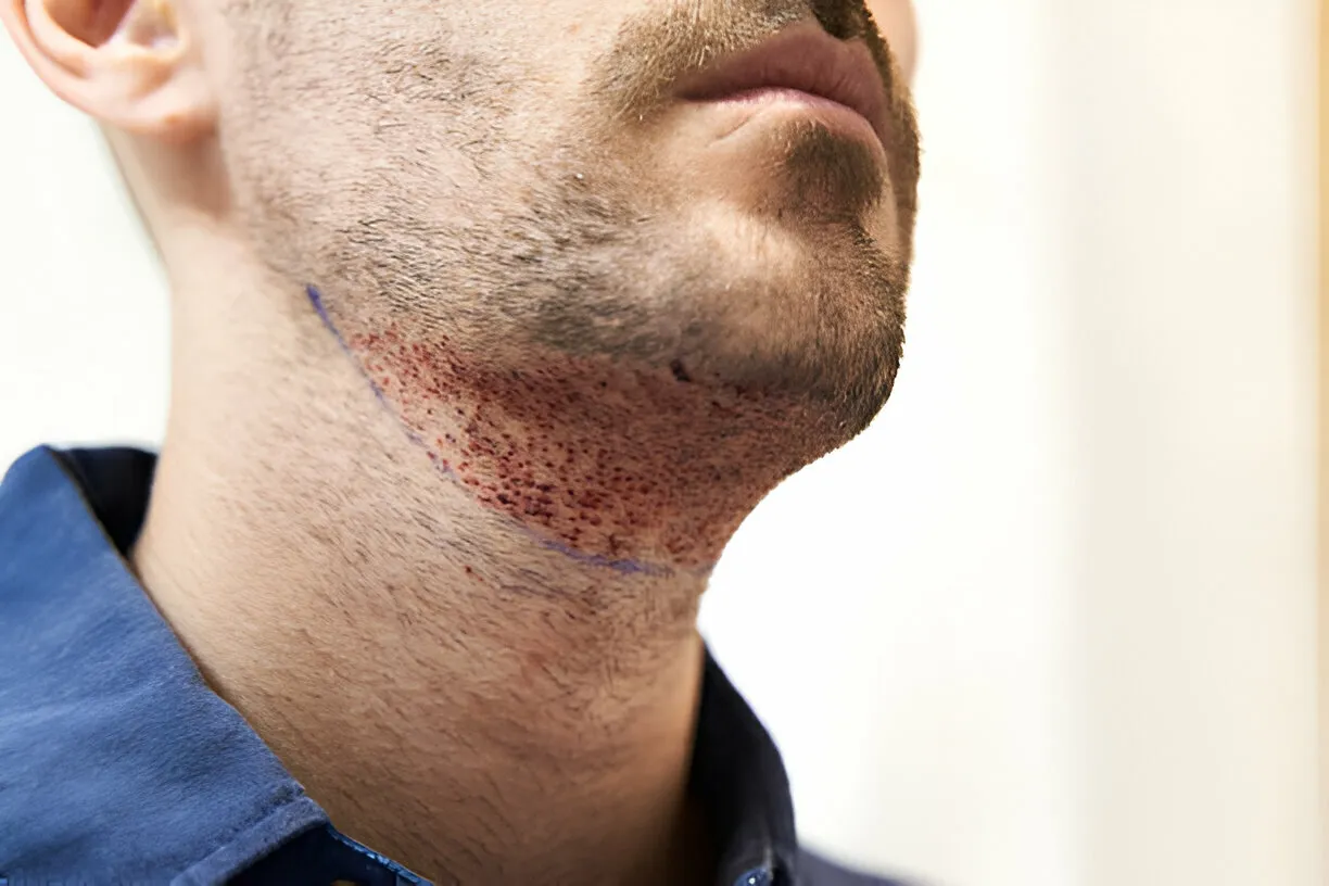 A Comprehensive Guide to Beard Transplant in Turkey Explained - Step By Step Process