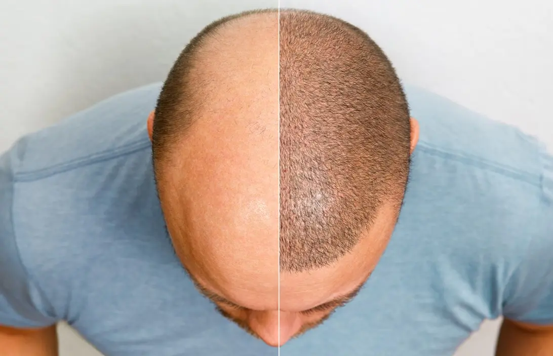 Do You Want Your Hair to be Healthy Again Get a Hair Transplant
