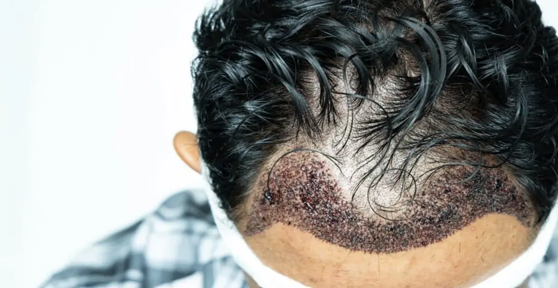 Do You Want Your Hair to be Healthy Again Get a Hair Transplant