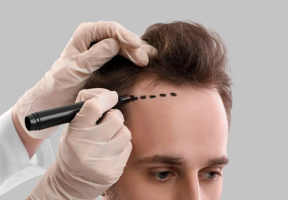 Do You Want Your Hair to be Healthy Again Get a Hair Transplant
