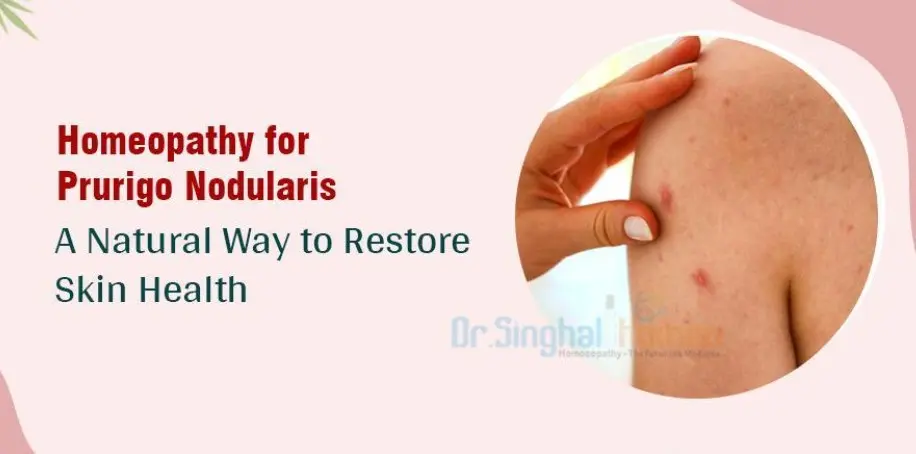 homeopathy treatment for prurigo nodularis